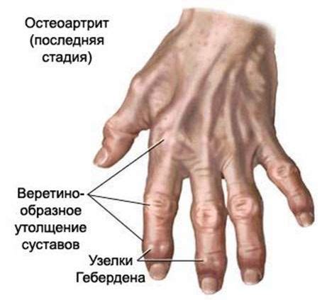 wikipedia artrit artrozu